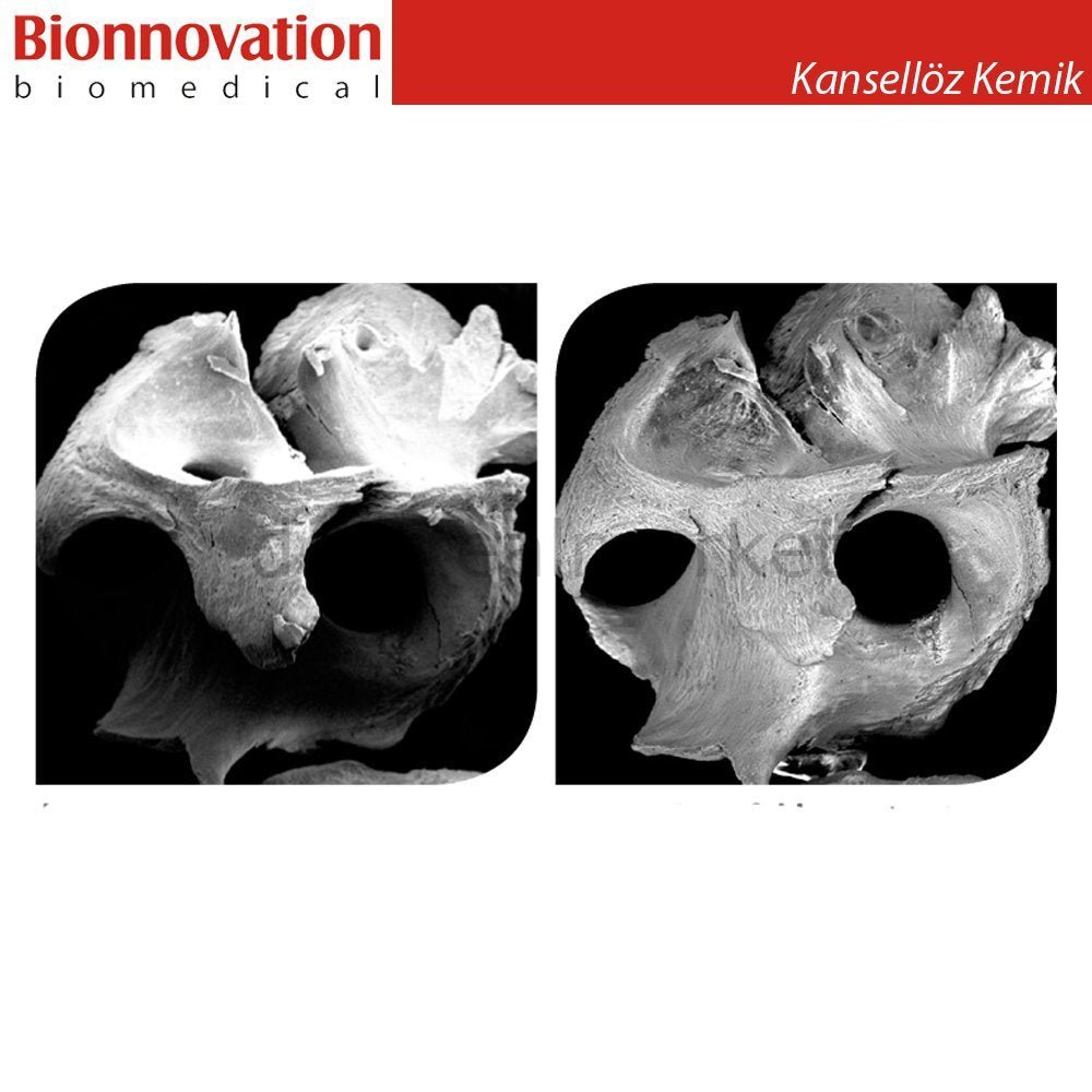 Bionnovation - Bonefill Prous (Cancellous) Bovine Graft - Xenograft - 5 gr (10cc)