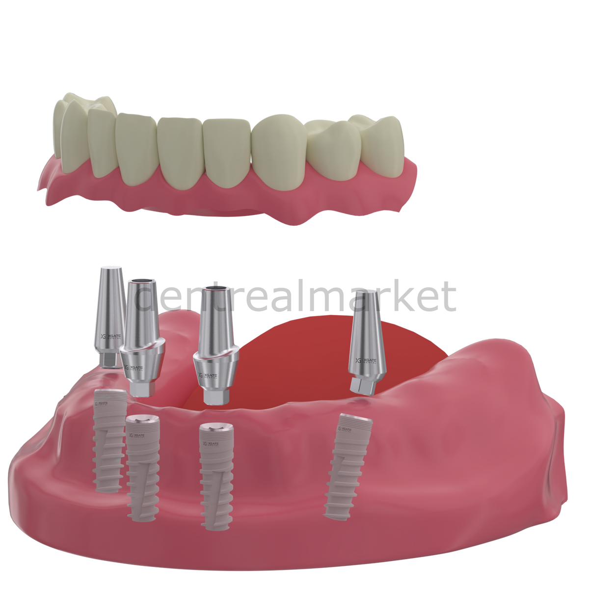 DentrealStore - X-Gate Dental X3 Internal Hex Implant Body - Diameter 5.0 mm - Single Platform Implant