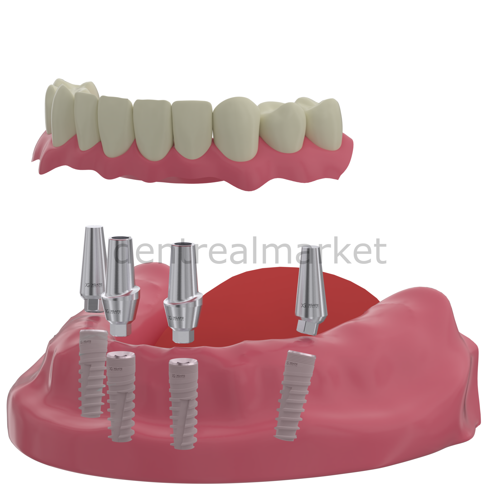 DentrealStore - X-Gate Dental X3 Internal Hex Implant Body - Diameter 5.0 mm - Single Platform Implant