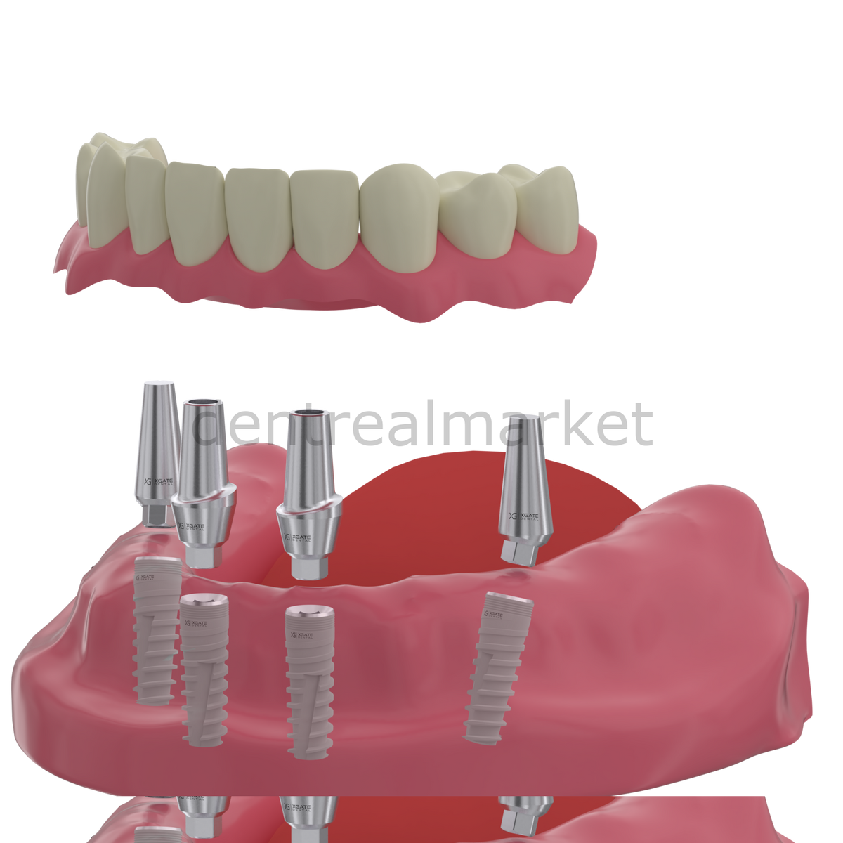 DentrealStore - X-Gate Dental X3 Internal Hex Implant Body - Diameter 4.2 mm - Single Platform Implant