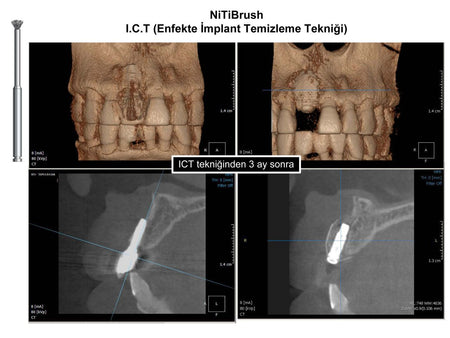 Dentkonsept - Nitibrush Peri - Implantitis Bur Refill Pocket