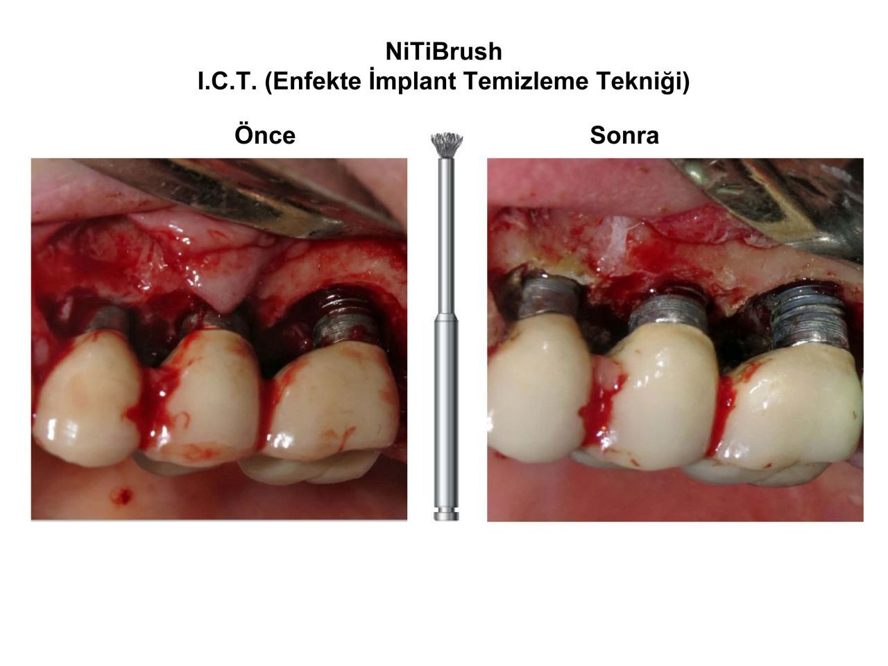 Dentkonsept - Nitibrush Peri - Implantitis Bur Set - 4 Pcs