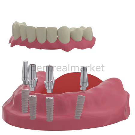 X - Gate Dental - X3 Internal Hex Implant Body - Diameter 3.75 mm - Single Platform Implant