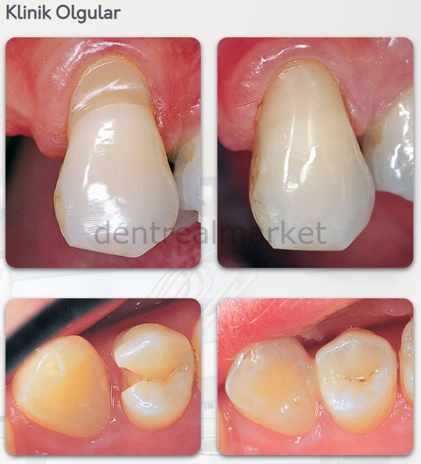 DentrealStore - Pentron Flow-It ALC Flowable Composite - 6x1,5 gr - B1